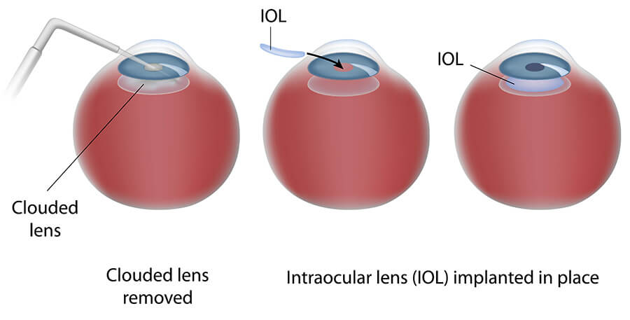 Chart Illustrating the Laser Cataract Surgery Process